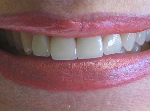 Caroline post-op crown work and veneer combination to fix broken teeth after fall