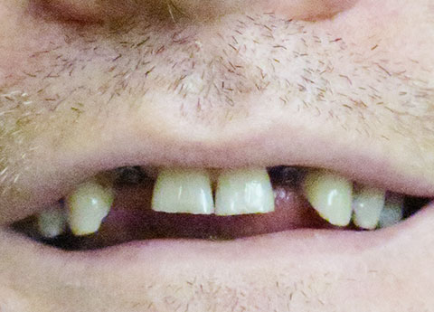 David Pre-Op Missing Teeth Replaced with Implants